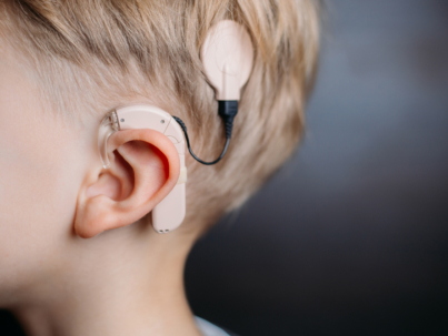 cochlear implant